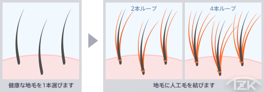 TZK増毛の結着増毛技術