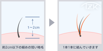 ステルス増毛の生え際増毛技術